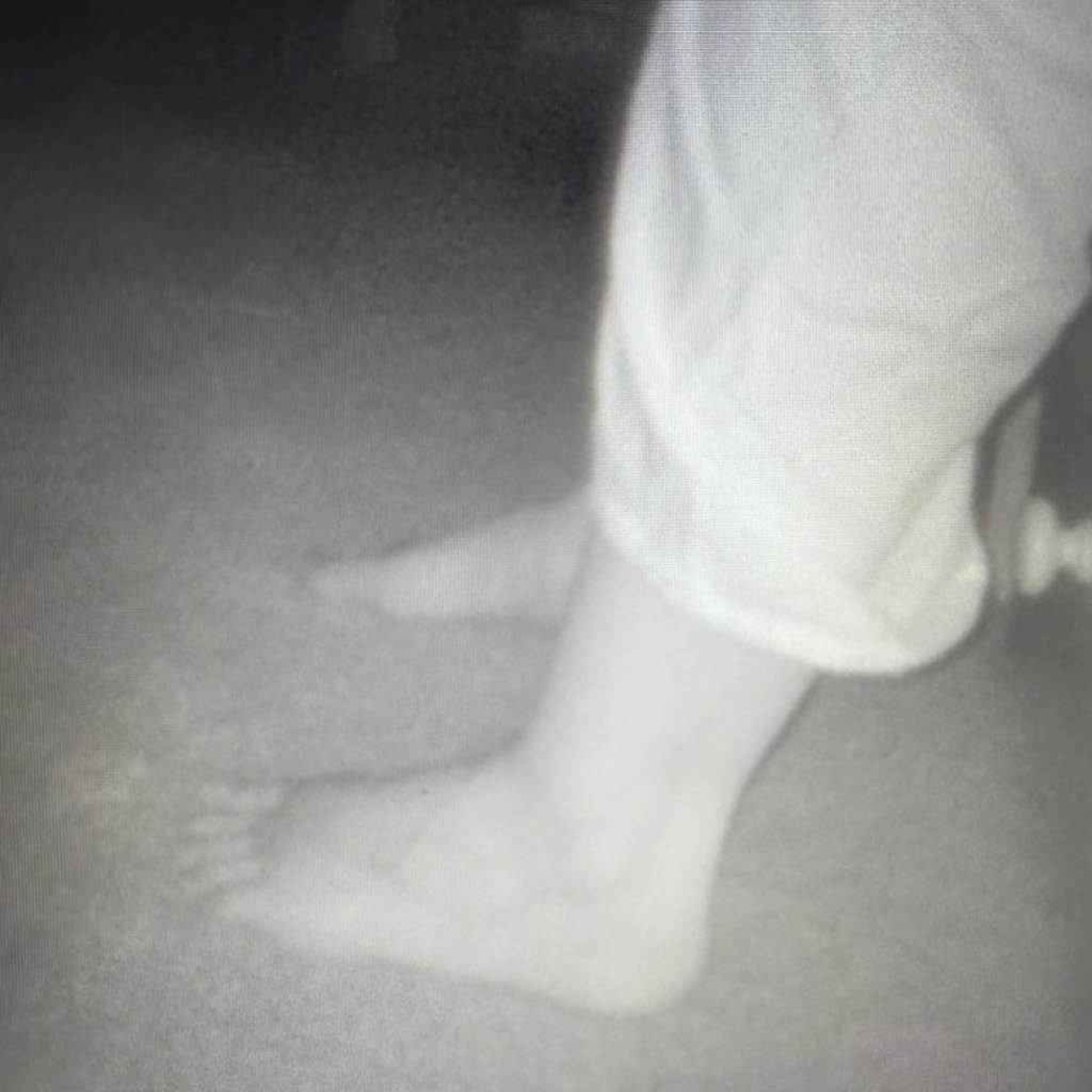 AI foot scanner spots early warning signs of heart disease