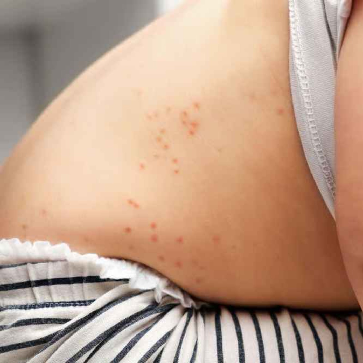Chickenpox vaccine to be made available on NHS