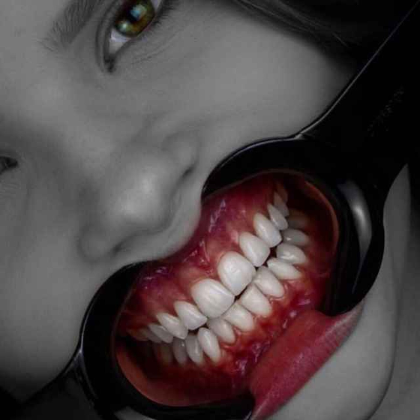 146- Zirconia without Zirconia implant restorations