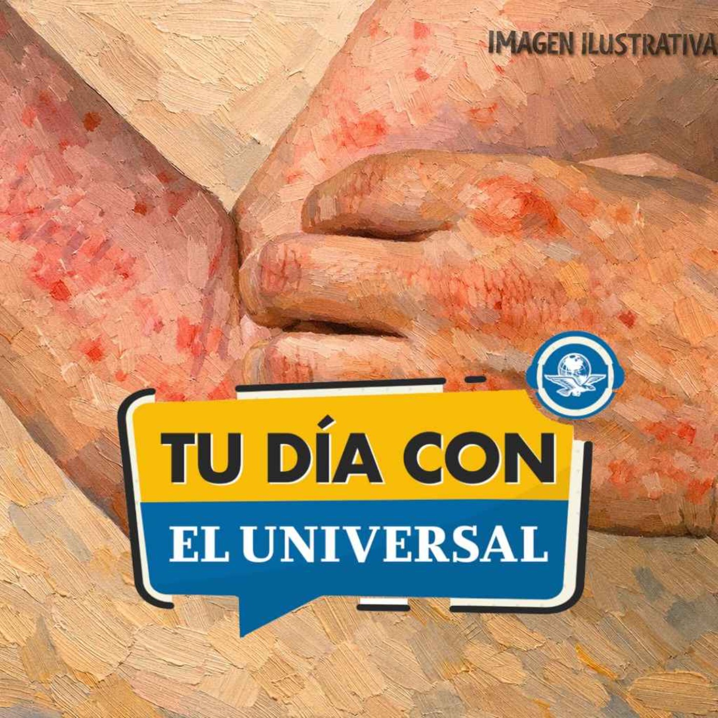 Aumentan contagios de sarampión en México: ¿cuáles son los síntomas? episode artwork