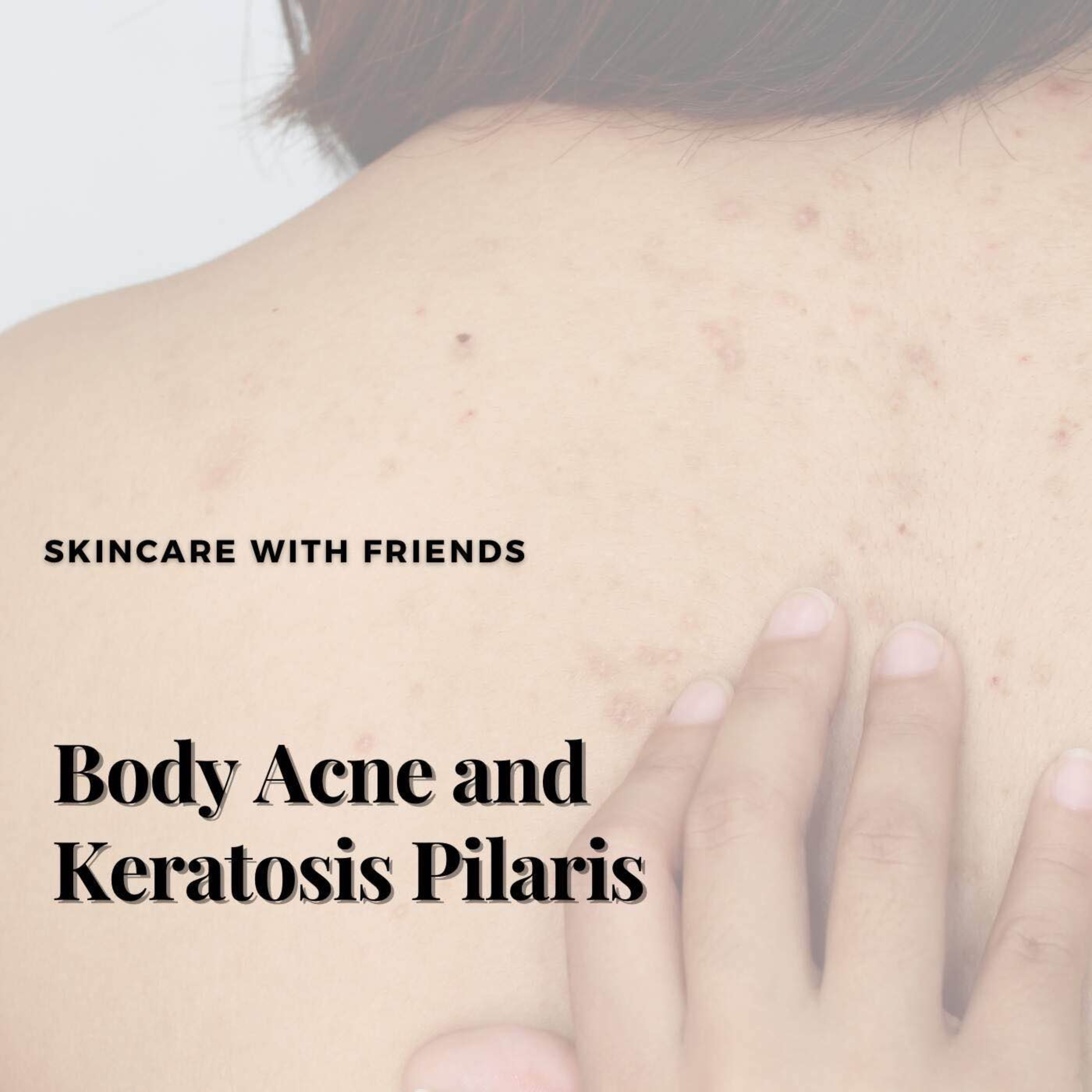 cover art for 79. Body Skincare- How to Get Rid of Body Acne and Keratosis Pilaris