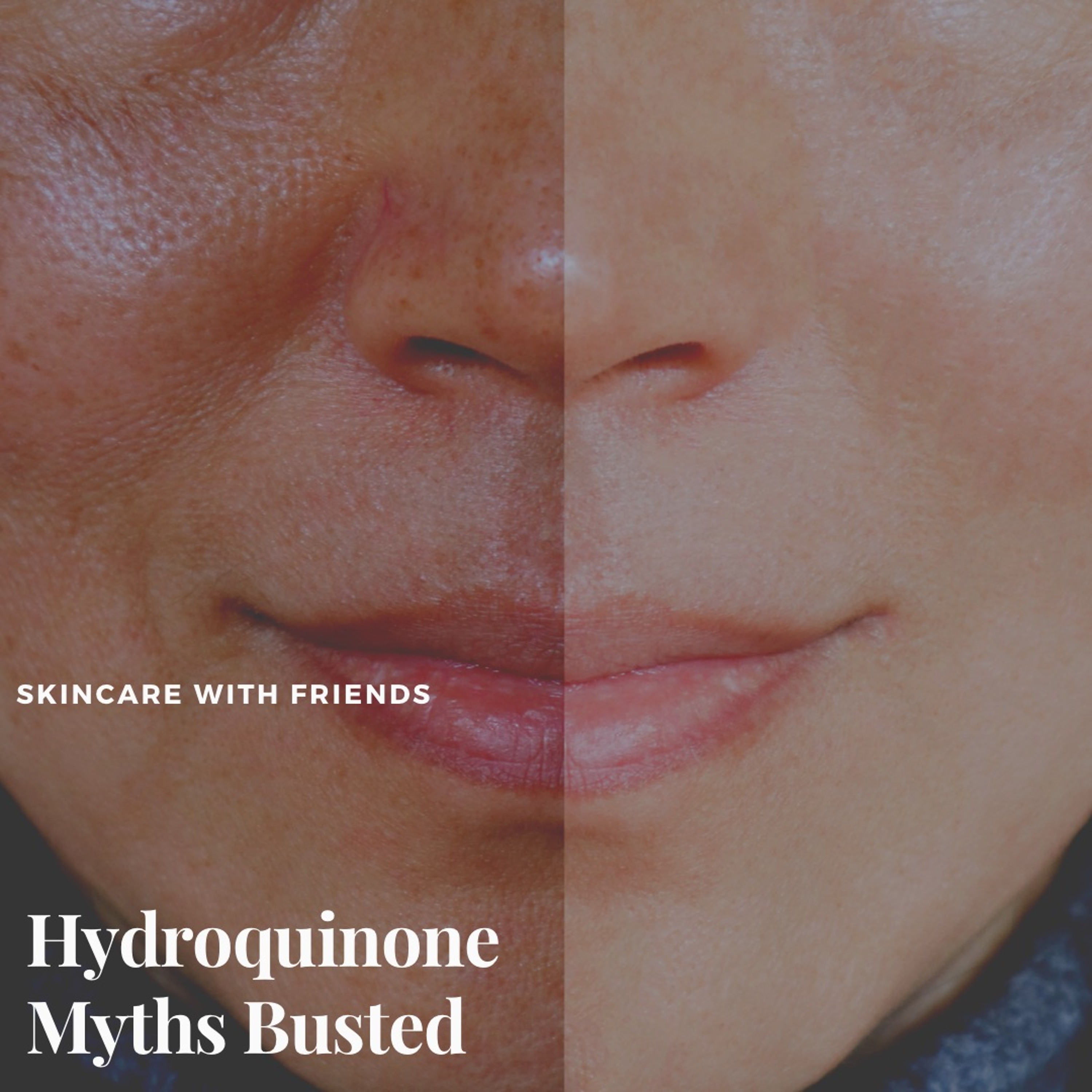 57. Hydroquinone Myths Busted