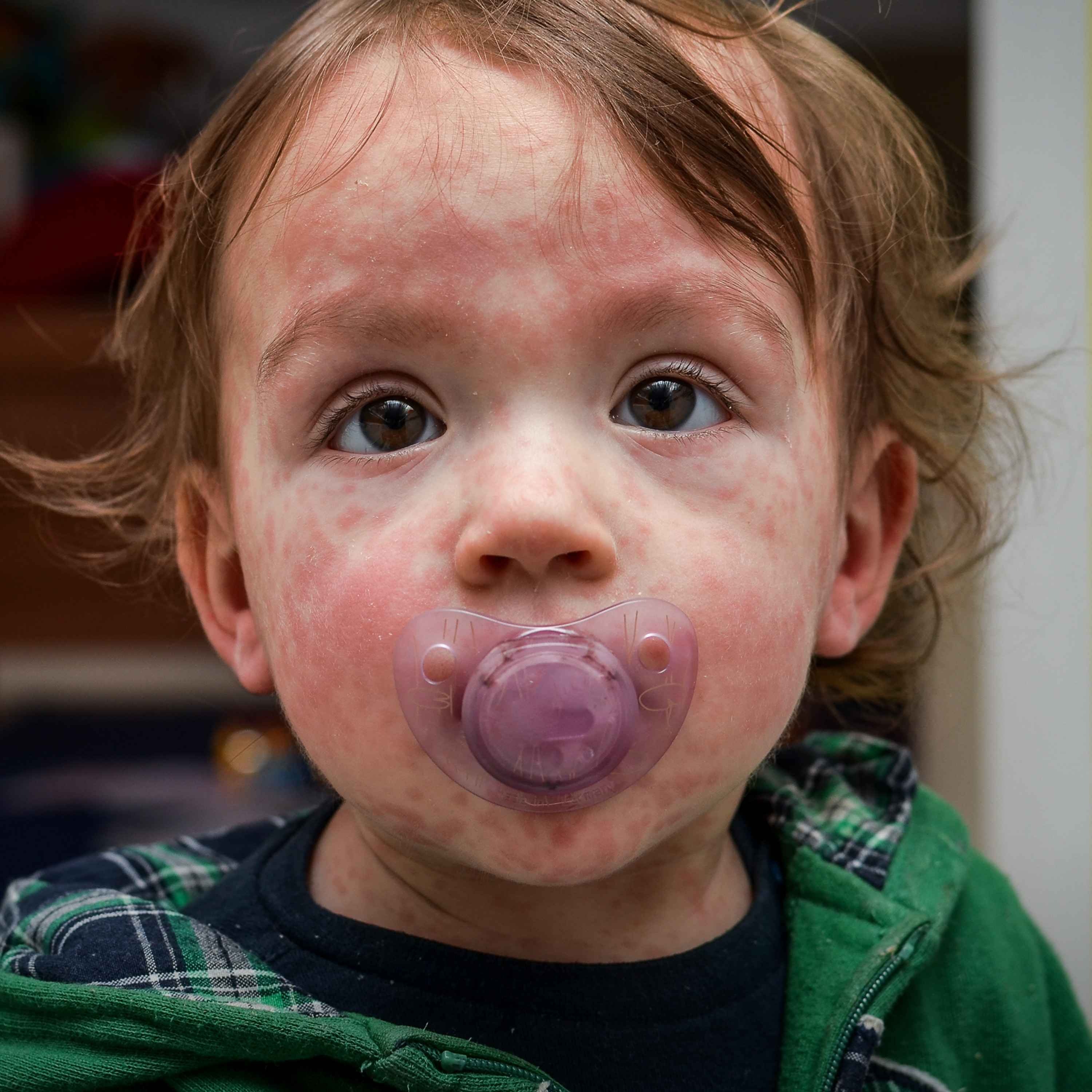 What's fueling a rise in measles cases in the UK?
