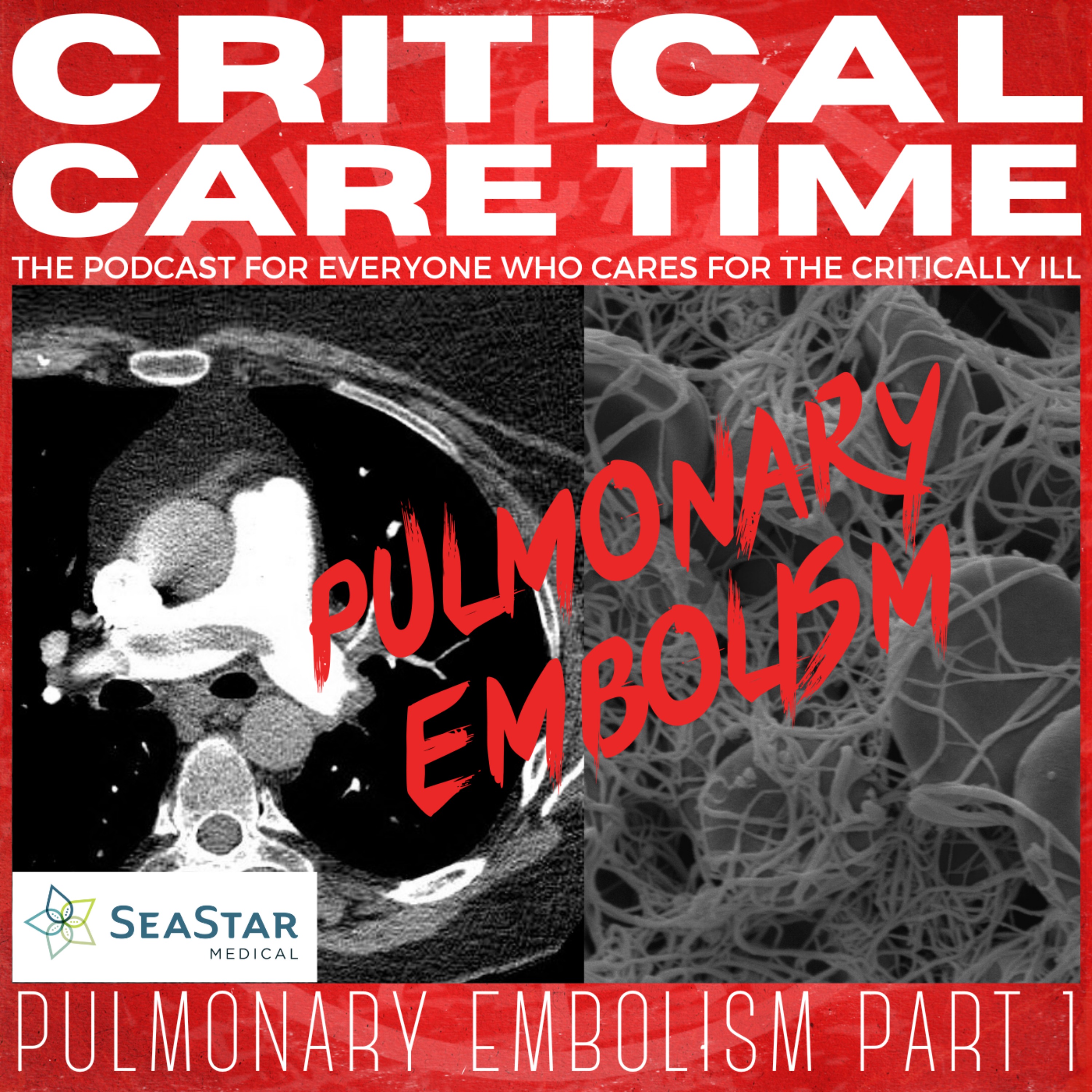 cover art for 15. Pulmonary Embolism Part 1