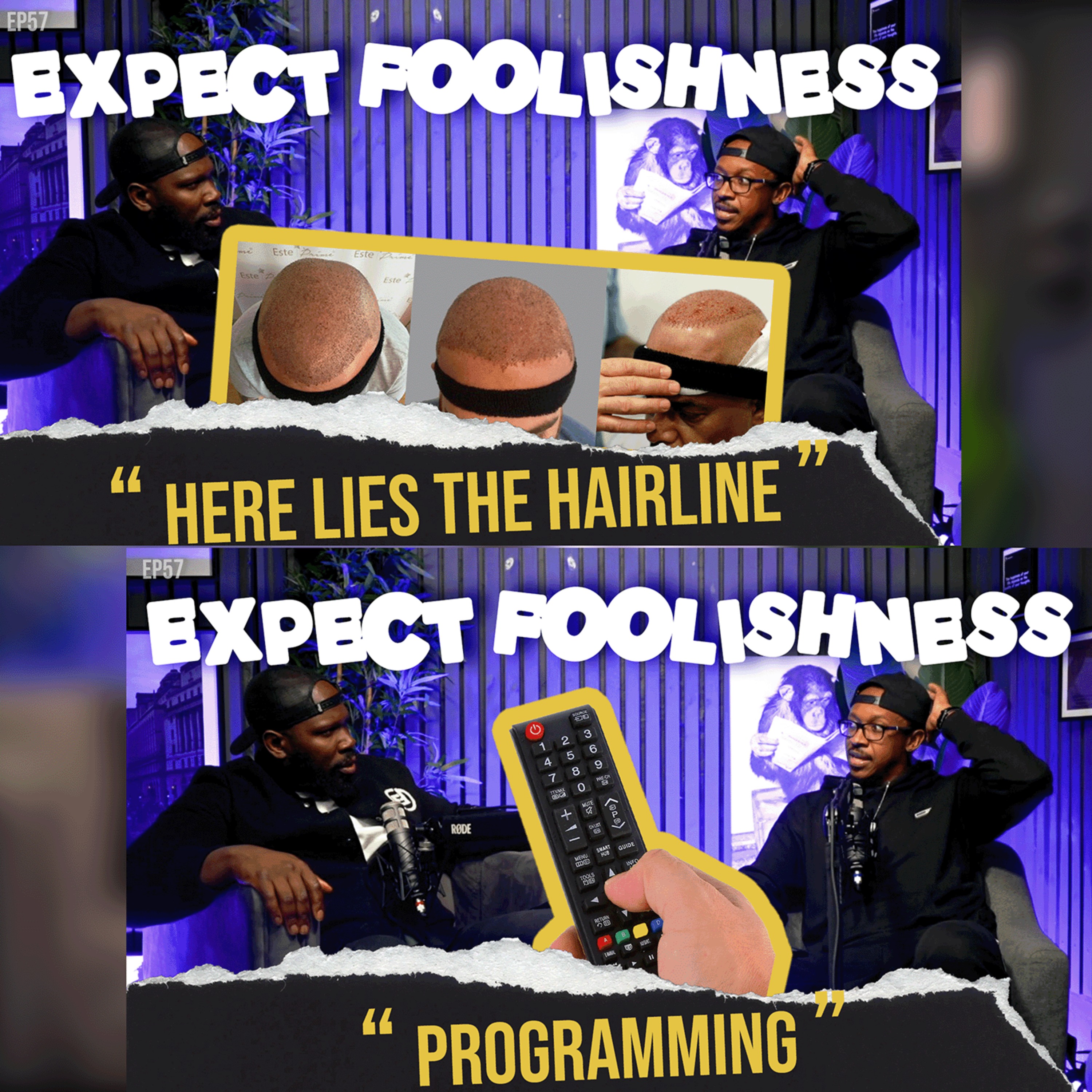 HERE LIES THE HAIRLINE | EP57 | EXPECT FOOLISHNESS #HAIRTRANSPLANT #HAIRLINE