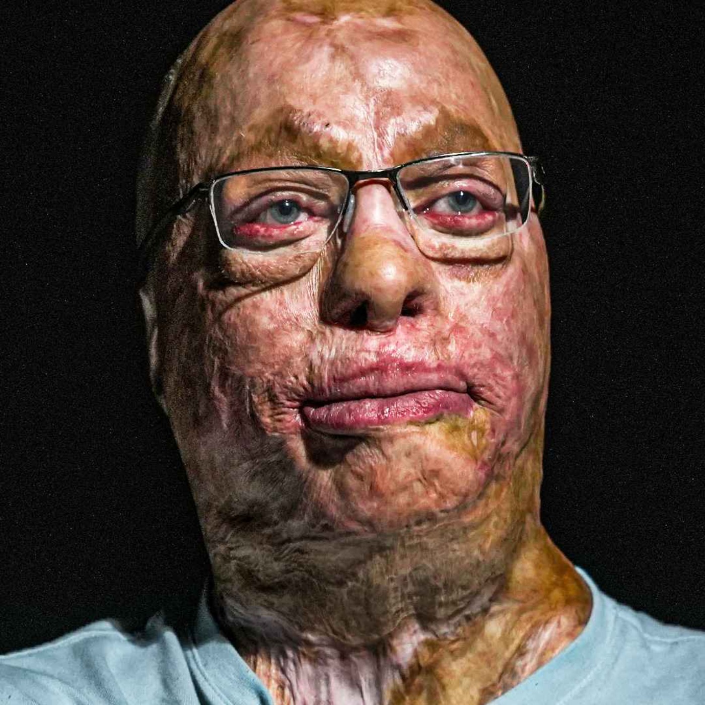E1: 90% of My Body Was Burnt, But I’m Thriving - Severe Burn Survivor Spencer Beach