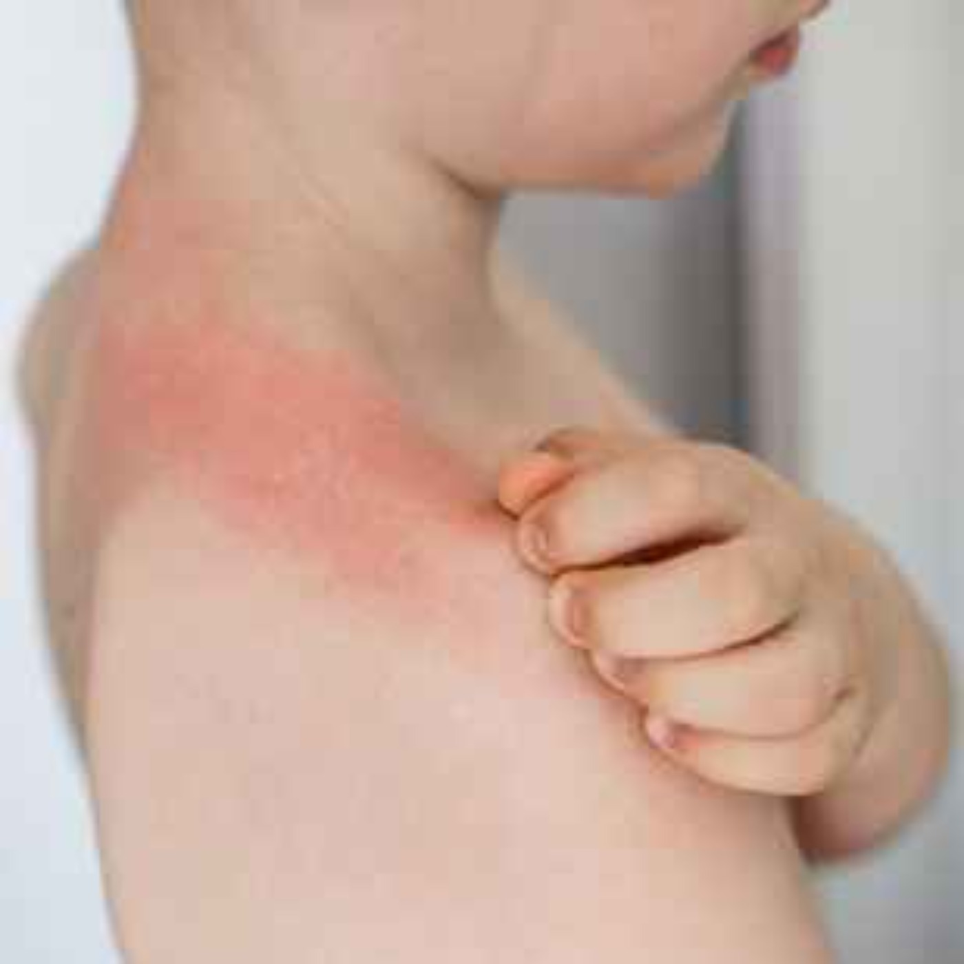 Ep. 78 - Varmeutslett, soleksem eller er dette allergi?
