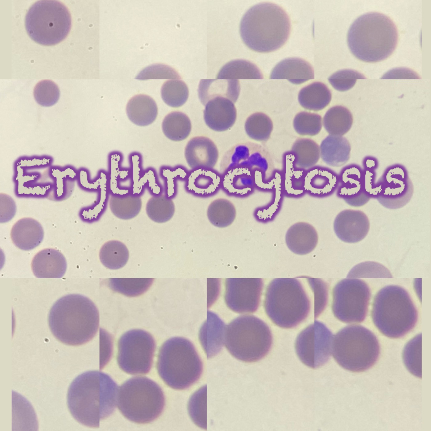 152 Erythrocytosis