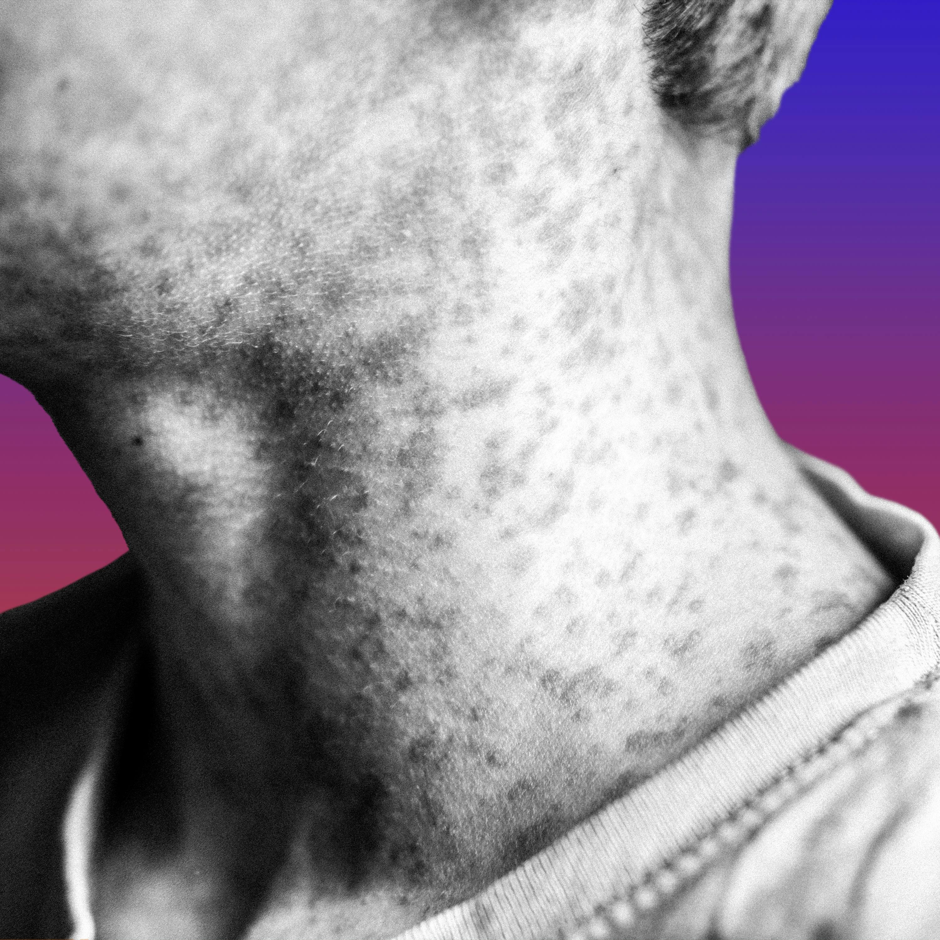 What Next | Daily News and Analysis - A Measles Outbreak and Wake-Up Call