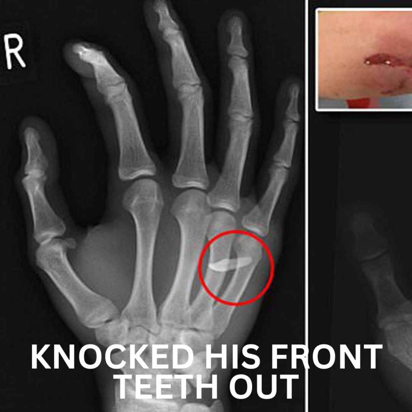 Knocked His Front Teeth Out episode artwork