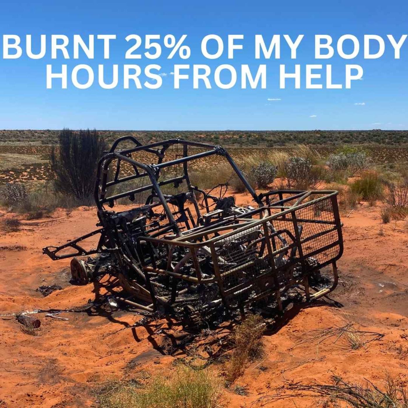 Burnt 25% Of My Body Hours From Help episode artwork