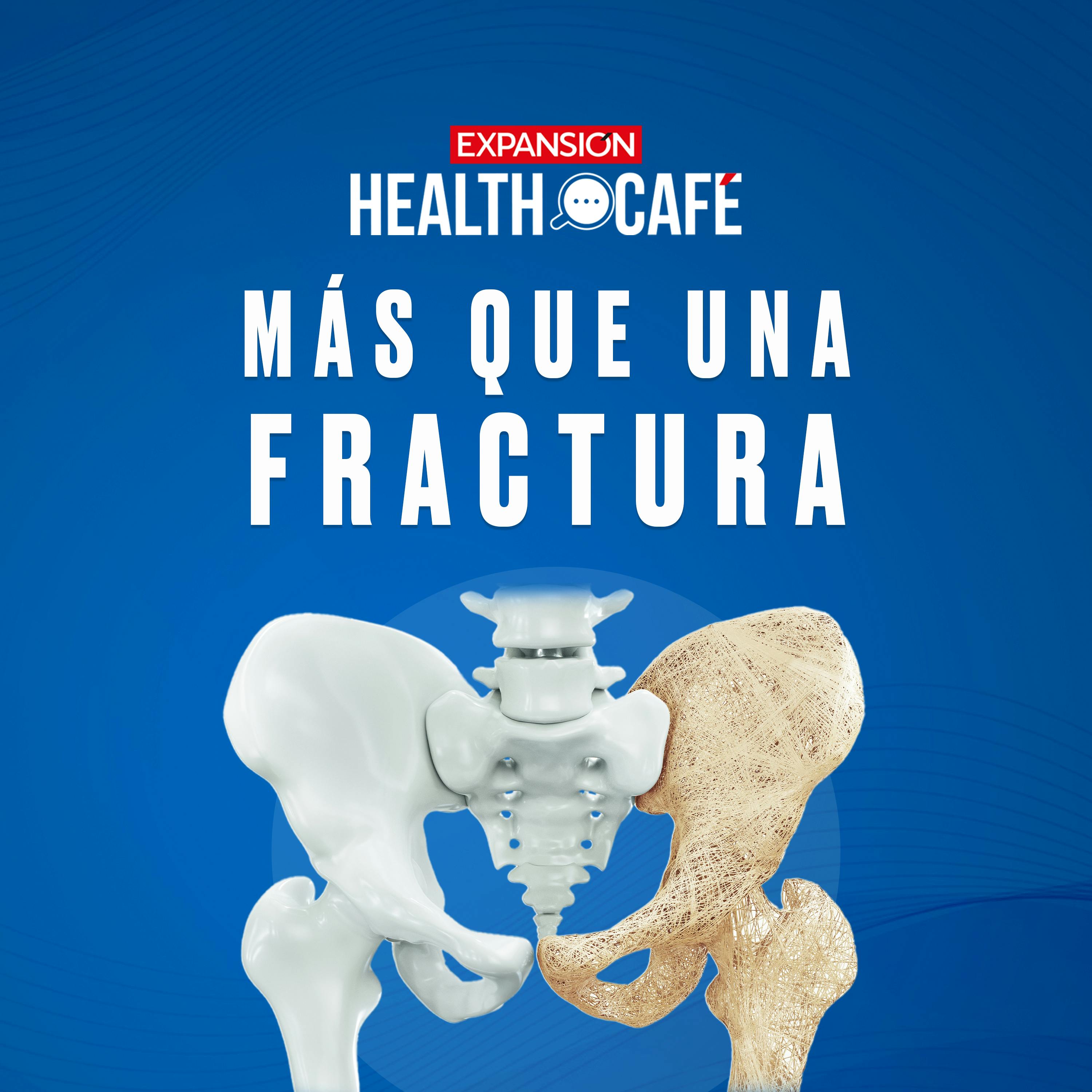 Osteoporosis: ¿Cómo cuidar tus huesos?