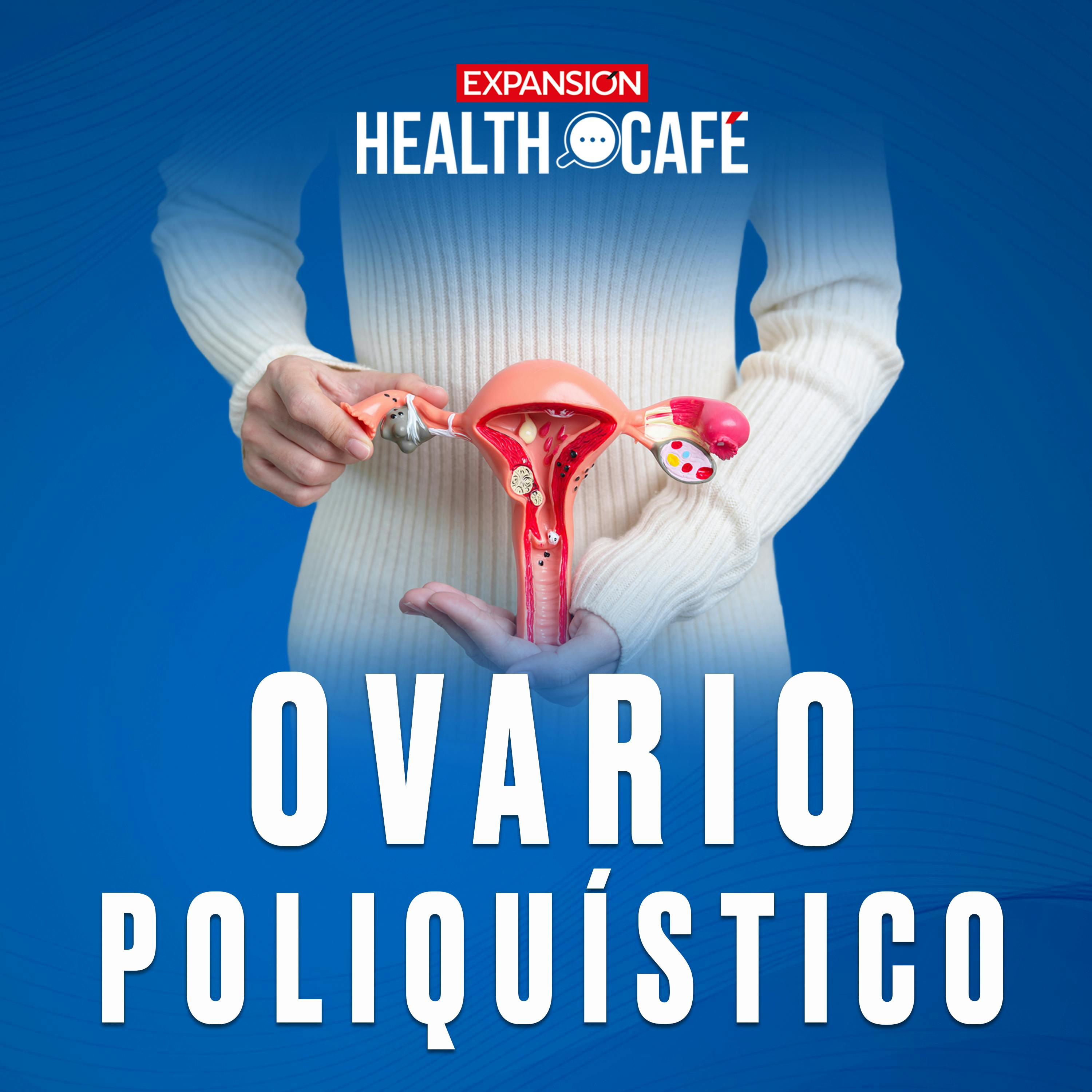 Síntomas del ovario poliquístico