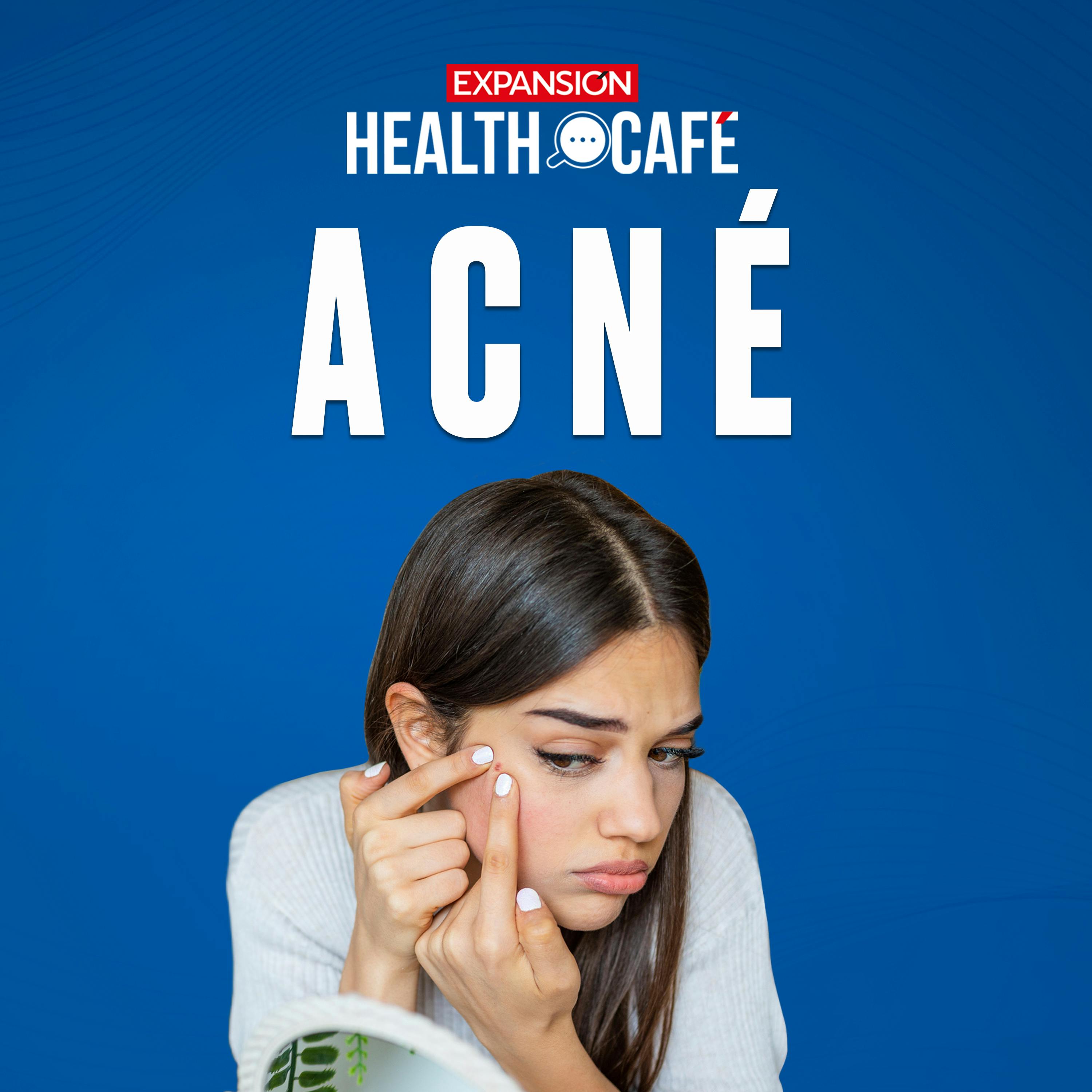 ¿Cómo se quita el acné?