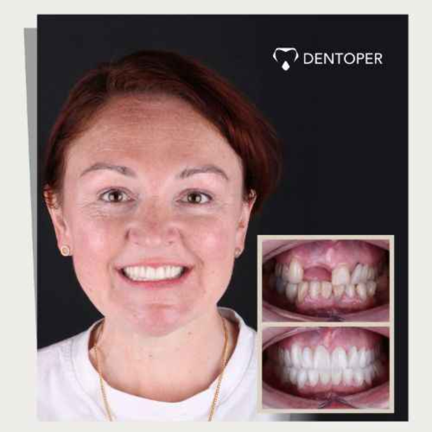 Melena Twain’s All on 6 Dental Implants Journey at Dentoper Fethiye